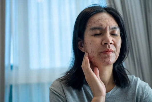 CBD mot Akne: En Naturlig Lösning?